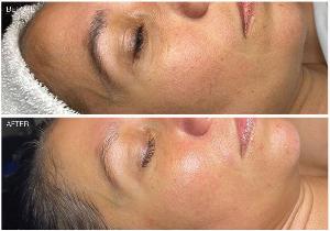 microdermabrasion - microderm