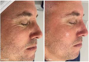 microdermabrasion - microdermabrasion