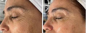 microdermabrasion - microderm
