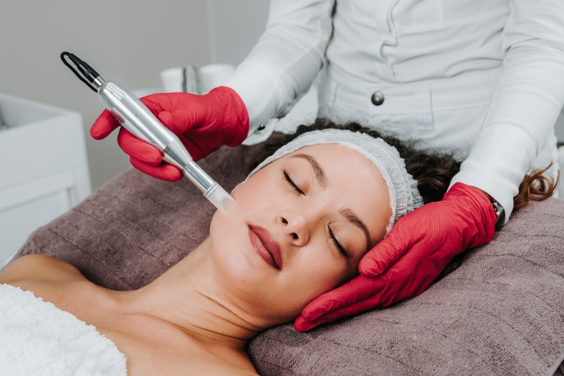 Woman receiving microneedling treatment - Tampa Bay.