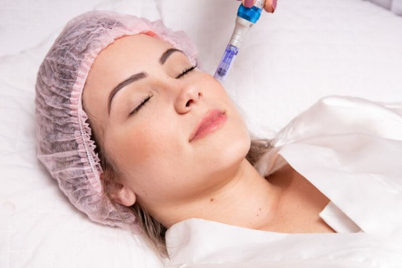 Beautiful woman receiving microneedling rejuvenation treatment in Tampa