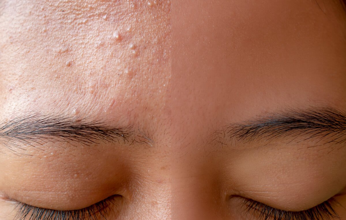 Acne Treatment in Tampa