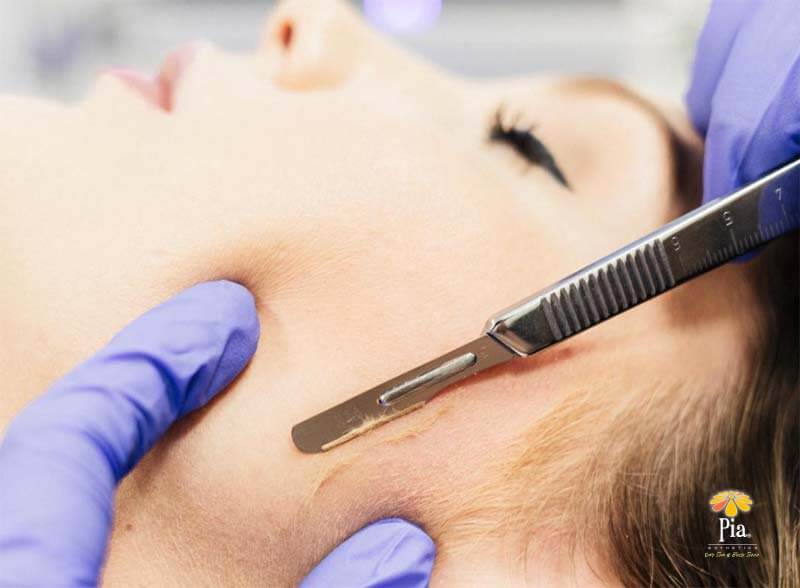 Tampa Bay Dermaplaning - Skincare